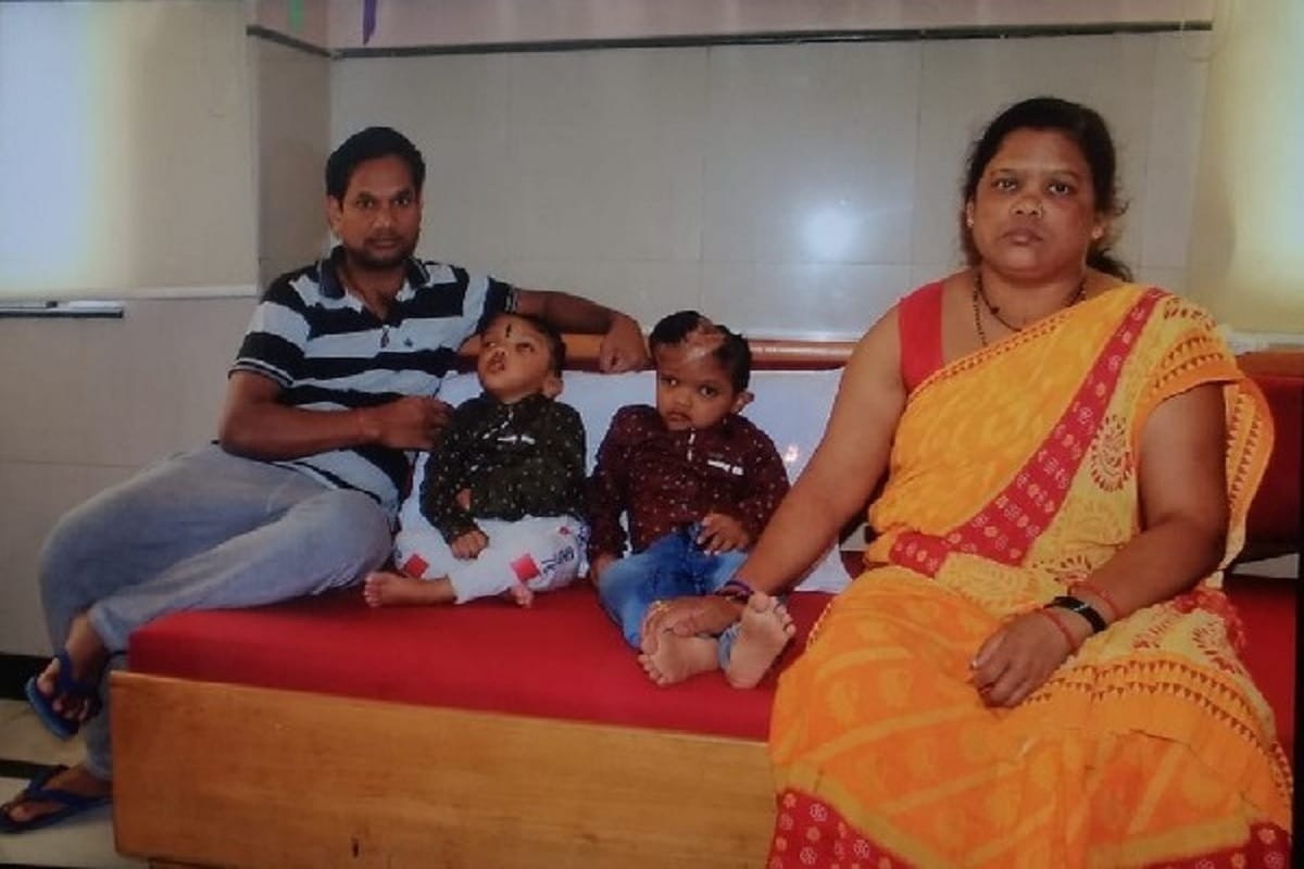 Odisha twin Jagga and Kalia separated through India first craniopagus surgery dies