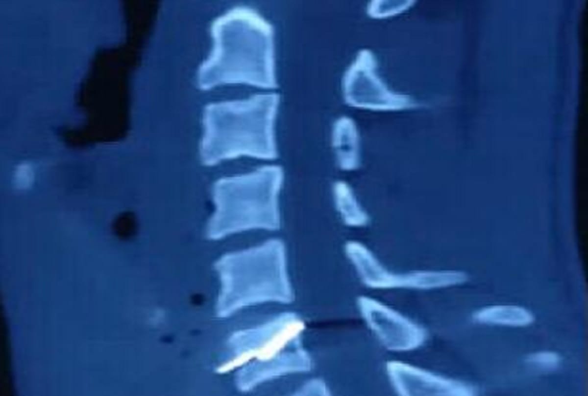 crude blast of animal scaring device proves costly to a bijnor boy suffers serious injury