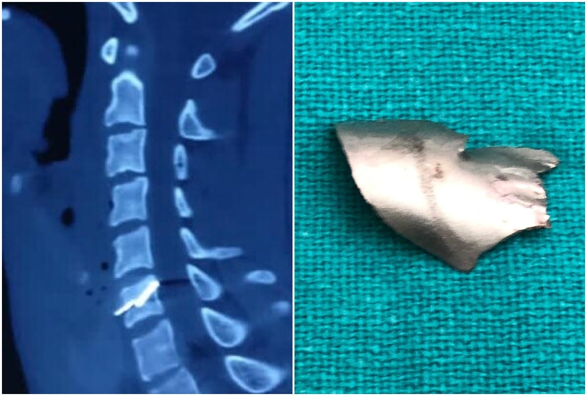 crude blast of animal scaring device proves costly to a bijnor boy suffers serious injury