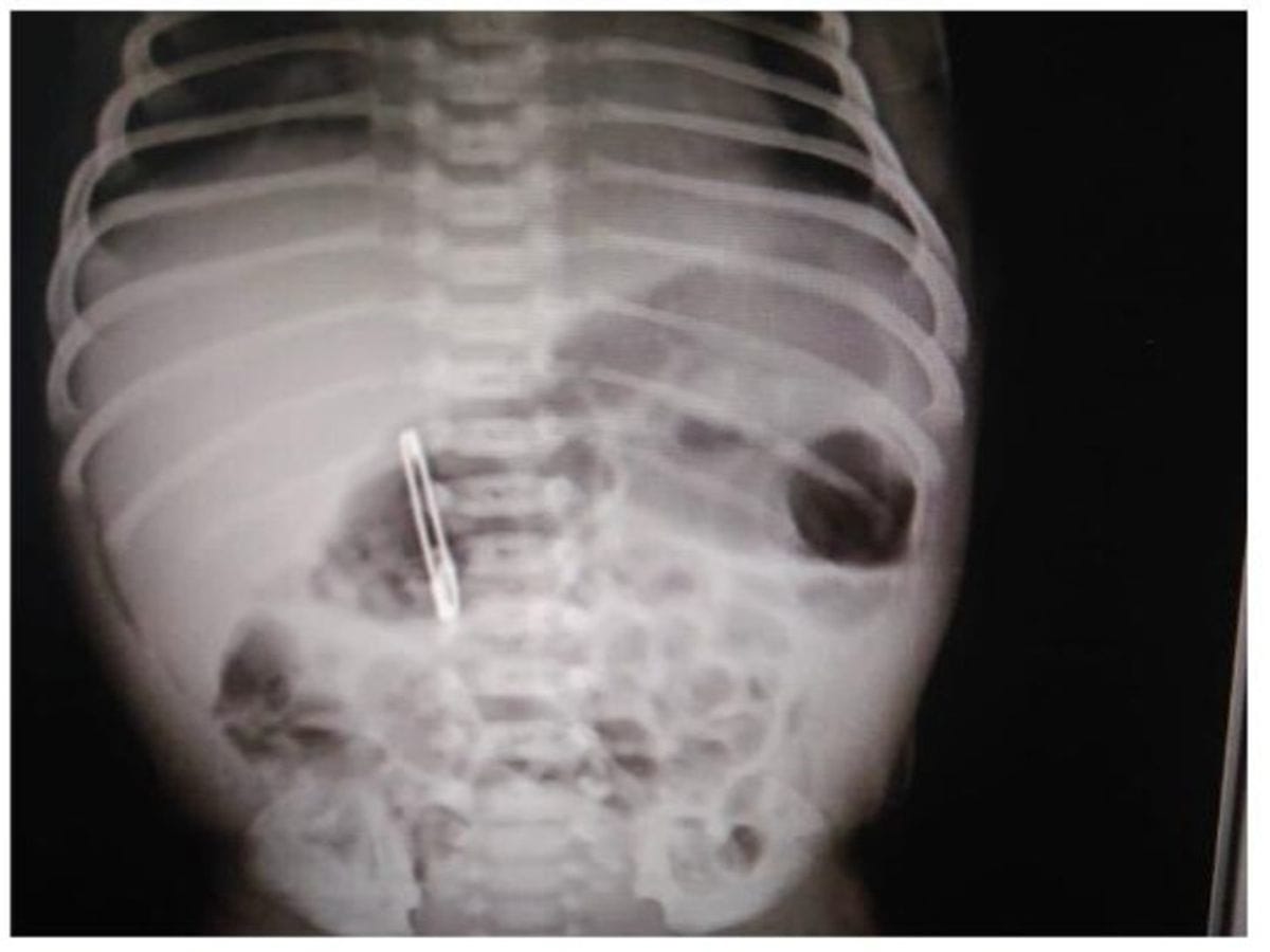bilaspur Chhattisgarh The Mother Was Cleaning With A Safety Pin  Baby Nose left hand went to stomach