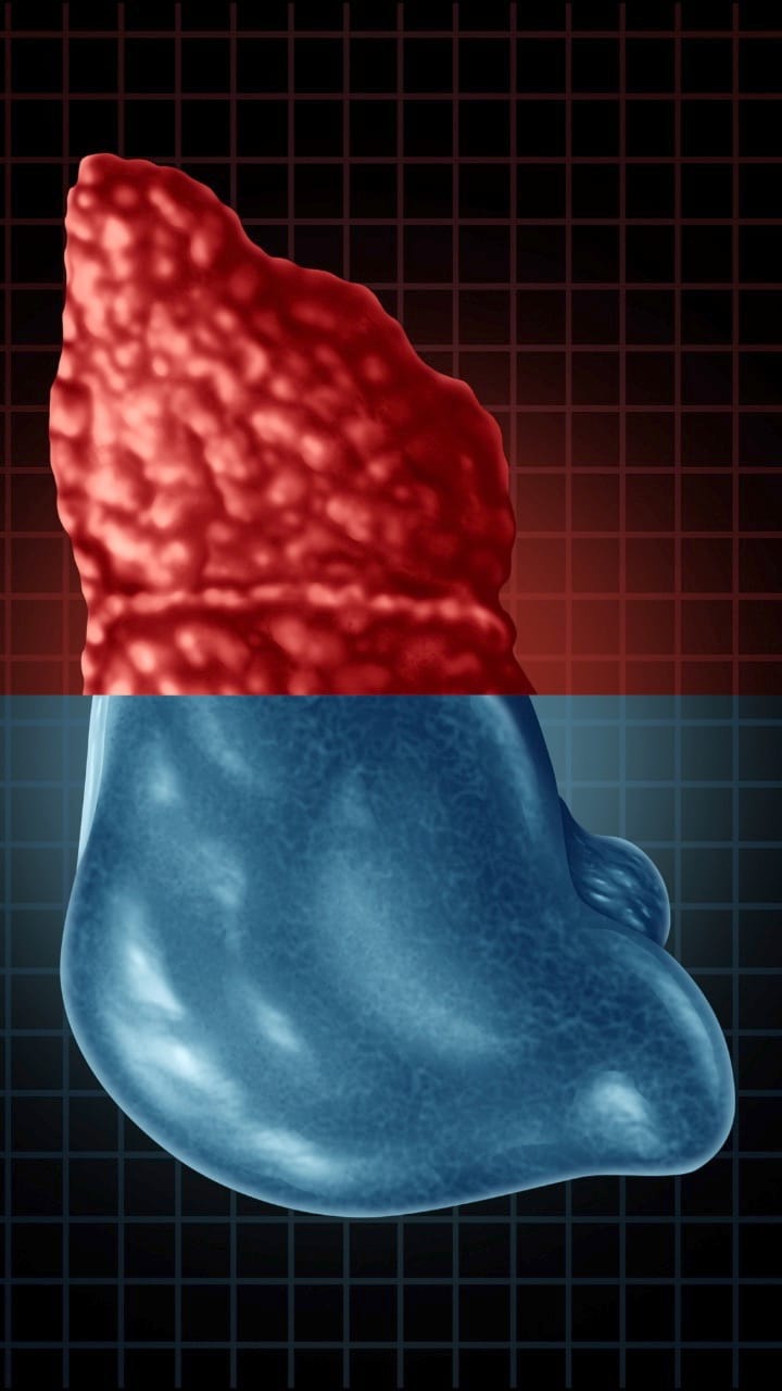 Liver is becoming fatty not only due to alcohol but also diabetes and high blood pressure