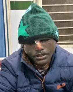 Young man scorched by fire in Junku forest