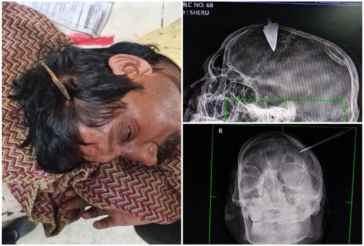 barwani 35 year old youth sher singh attacked by an arrow treatment in Indore my hospital