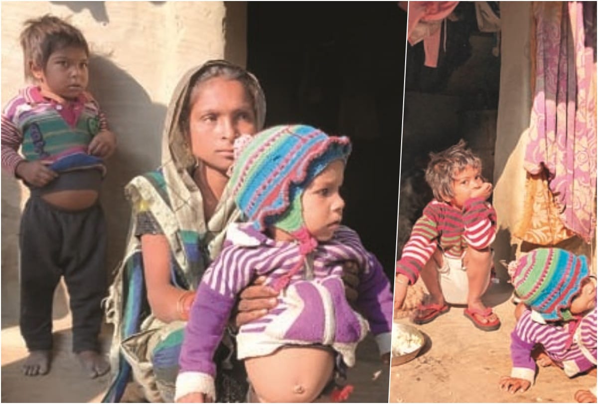 कुपोषण के शिकार बच्चे