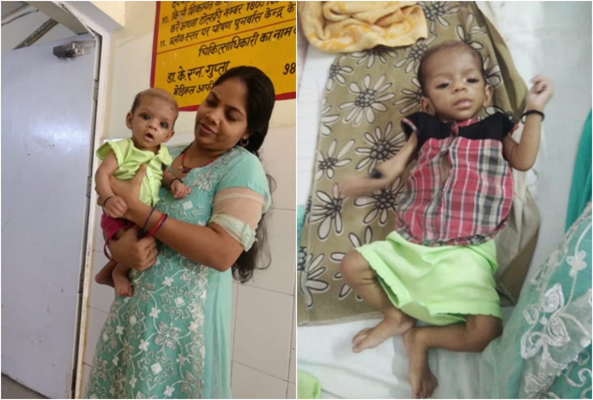 सुल्तानपुर में शहर के सदर मोहल्ले में कुपोषण के दौरान और एनआरसी में इलाज के बाद बच्चा अपनी मां ऐश्वर्या की गोद में।