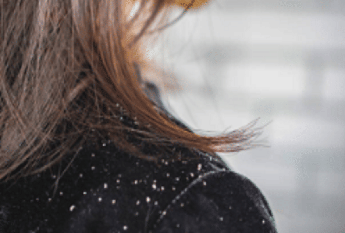 how to use egg to remove dandruff from hair