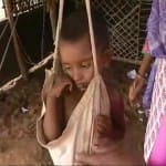 कुपोषण