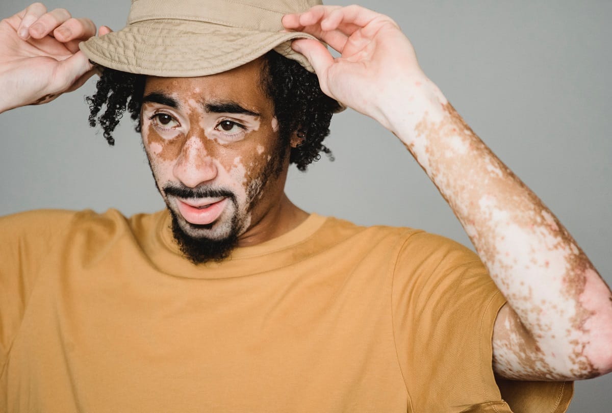 How dangerous is vitiligo disease