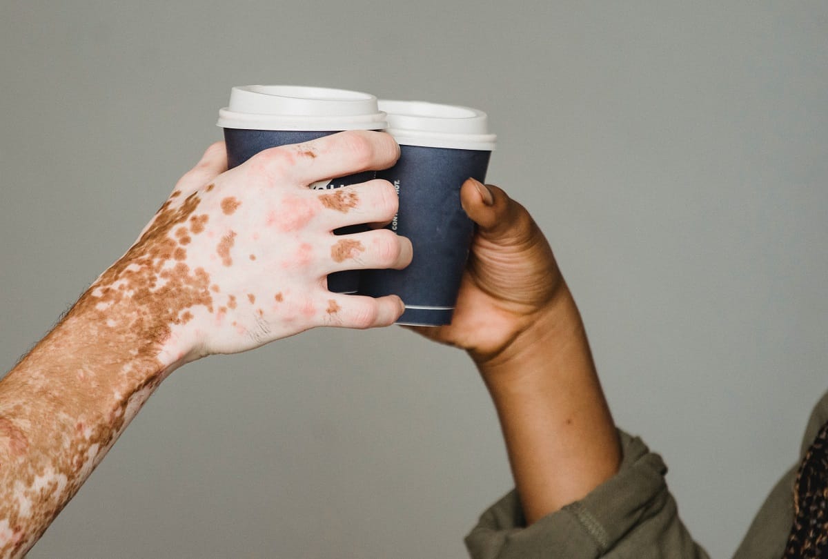 How dangerous is vitiligo disease