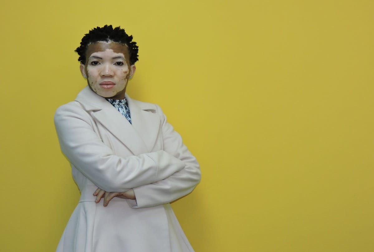 How dangerous is vitiligo disease