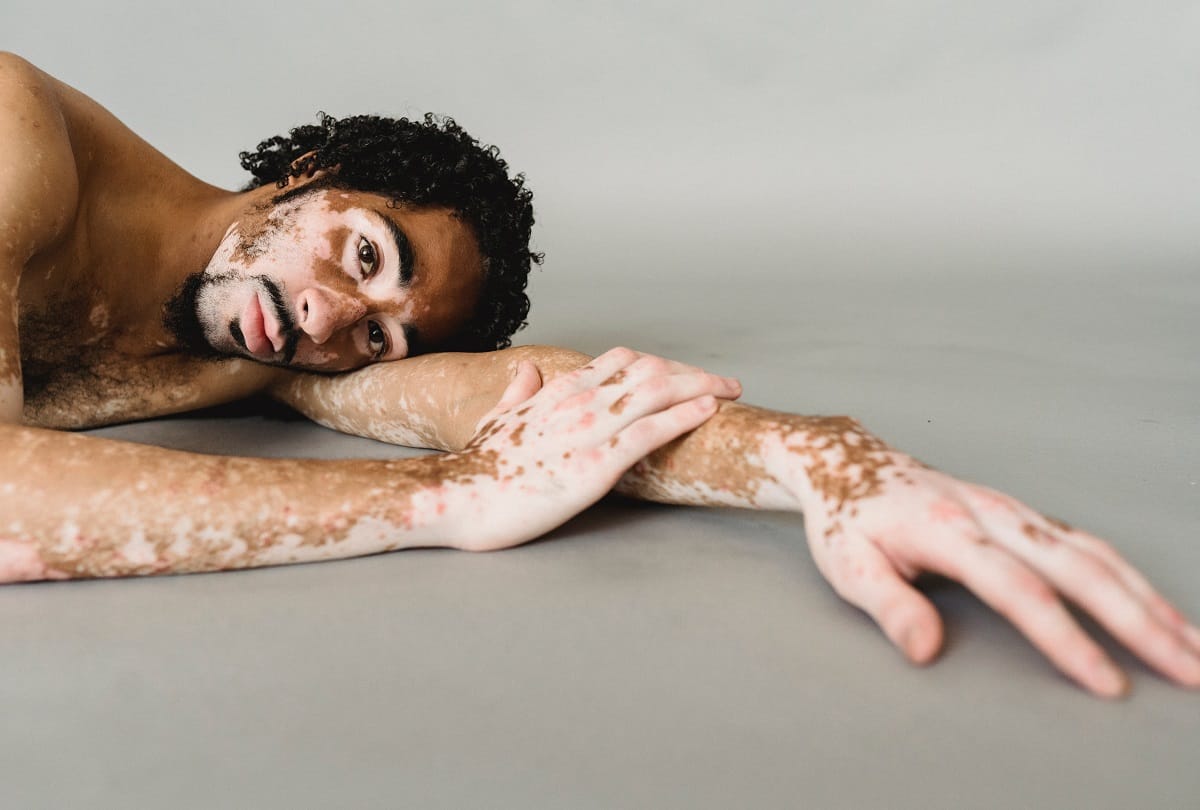 How dangerous is vitiligo disease
