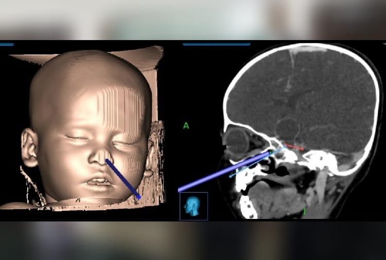 brain tumor surgery by nose of a 16 month old baby done successfully in PGI chandigarh