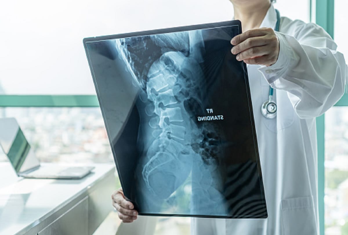 Spinal Muscular Atrophy Rare Genetic disease Causes Symptoms and Treatment
