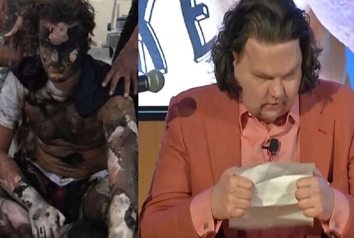 World's first face and hands transplant gives New Jersey man a second chance at life