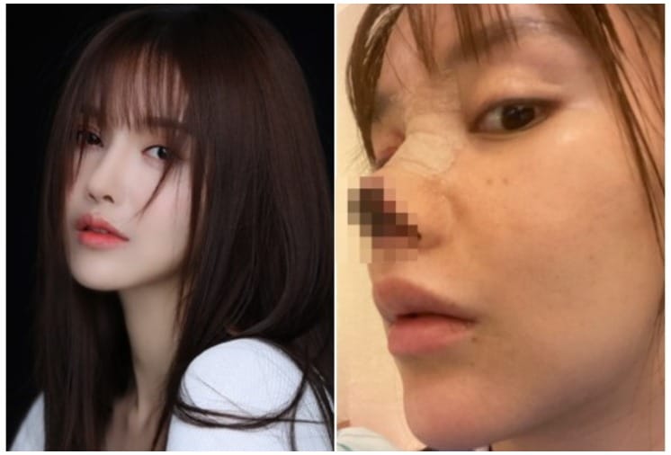 Chinese Singer Gao Liu Nose Surgery Shocking Pictures Goes viral
