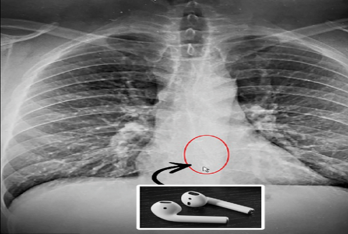us man swallows apple airpod in sleep