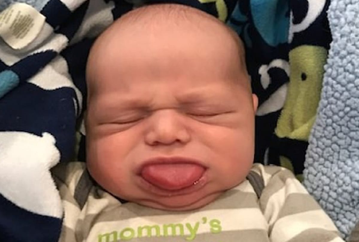 three year old boy tongue is four times too big for his mouth