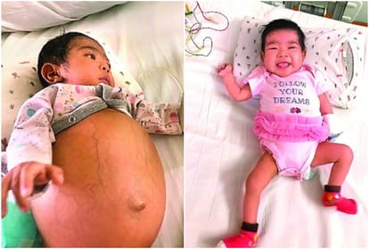Infection spread from throat to spinal cord life saved from surgery Indonesia Baby liver transplanted in apollo hospitals delhi
