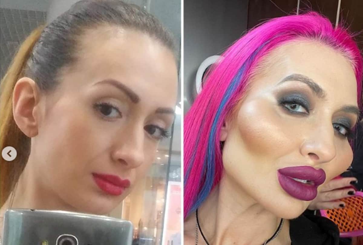Ukrainian model Anastasia Pokreshchuk world biggest cheeks has shared a picture before cosmetic surgeries