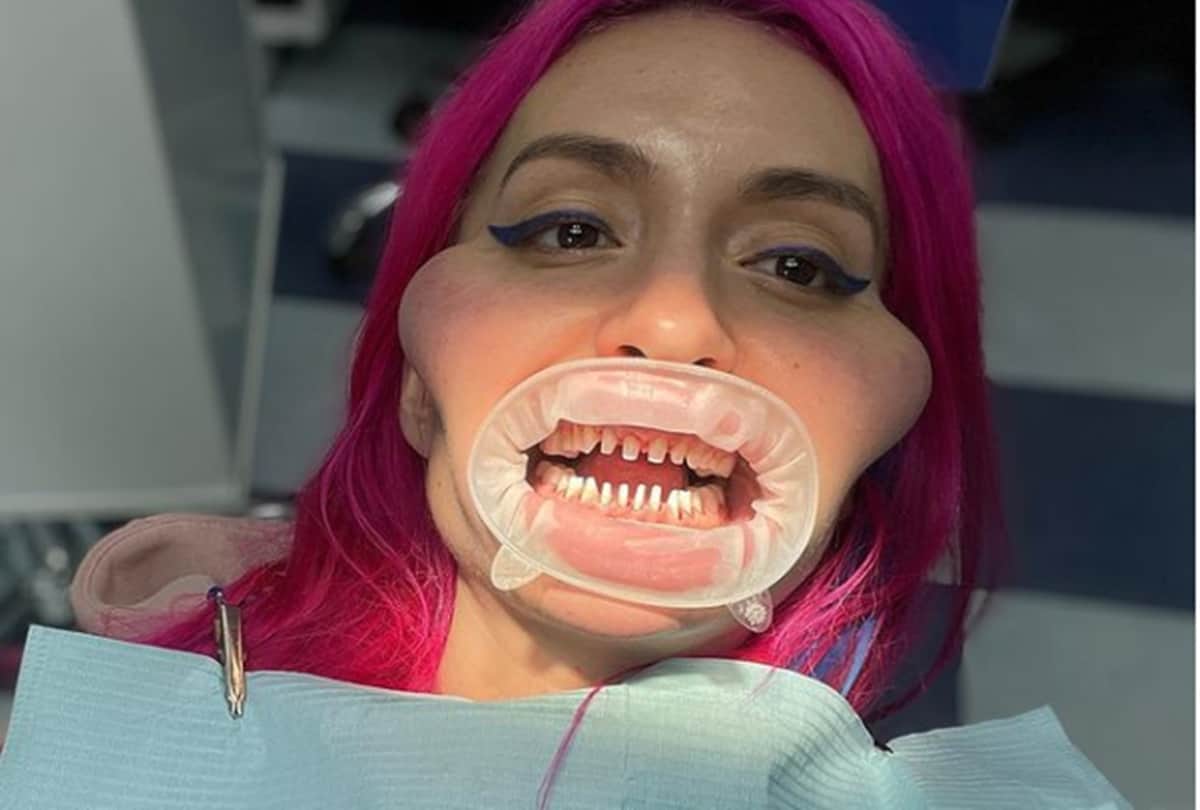 Ukrainian model Anastasia Pokreshchuk world biggest cheeks has shared a picture before cosmetic surgeries