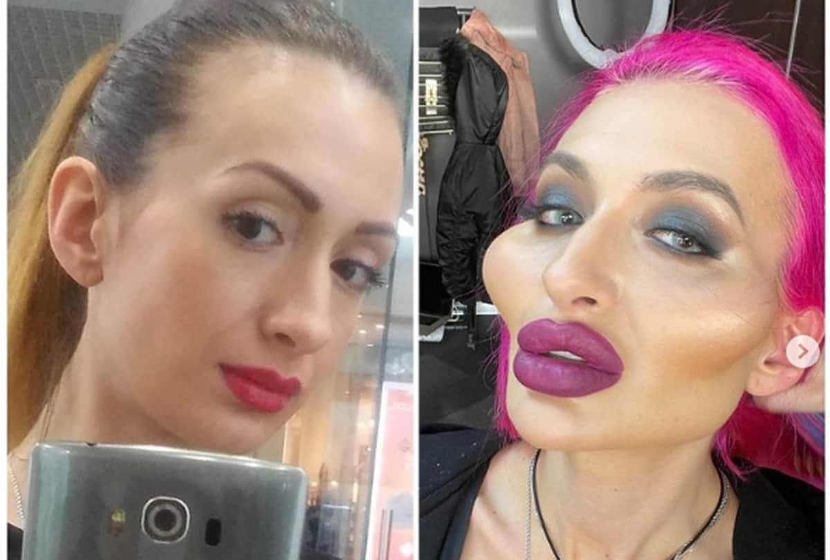 Ukrainian model Anastasia Pokreshchuk world biggest cheeks has shared a picture before cosmetic surgeries