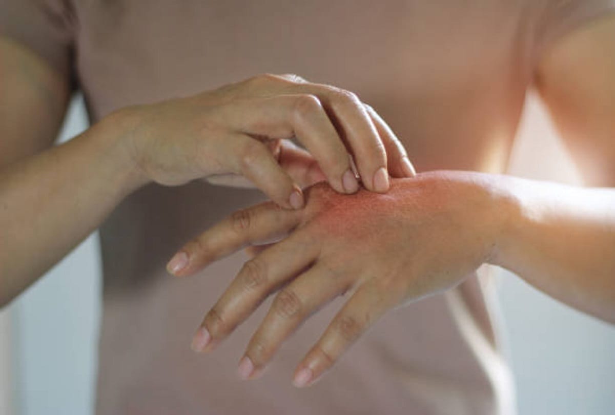 Coronavirus new study says Skin rashes can be a sign of covid 19
