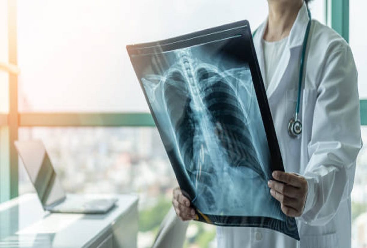 BPAL dose will reduce the treatment of Tuberculosis for six months