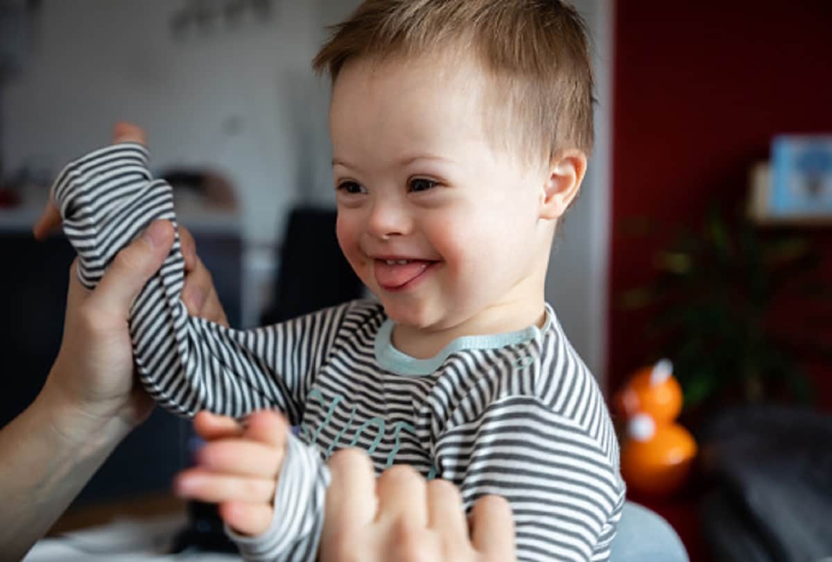 down syndrome also known as trisomy 21 causes and symptoms in hindi