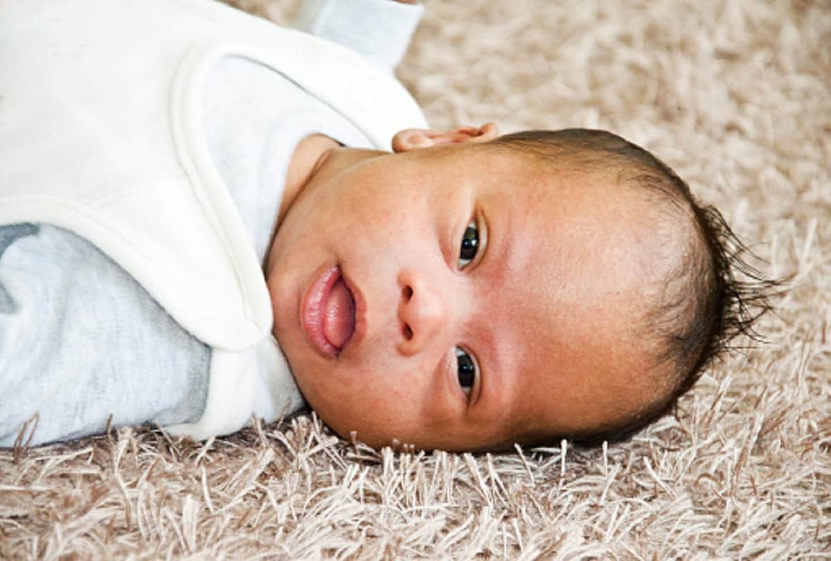down syndrome also known as trisomy 21 causes and symptoms in hindi