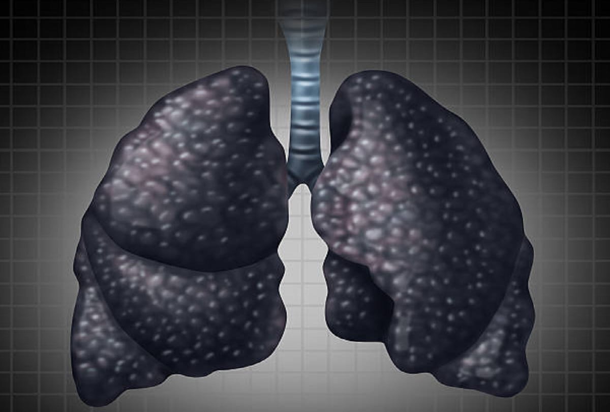 coal workers pneumoconiosis also known as Black Lung Disease Causes symptoms and prevention tips in hindi