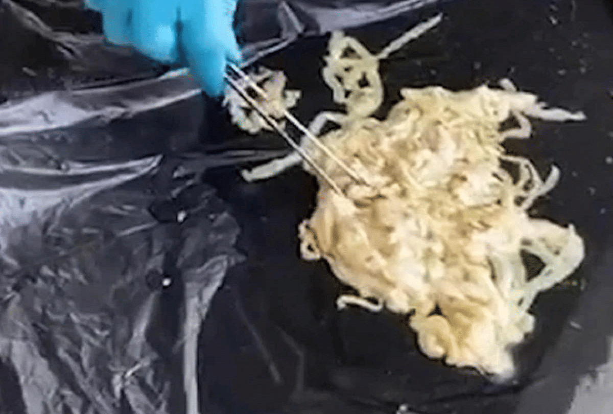 thailand 59 feet long tapeworm removed from mans rectum