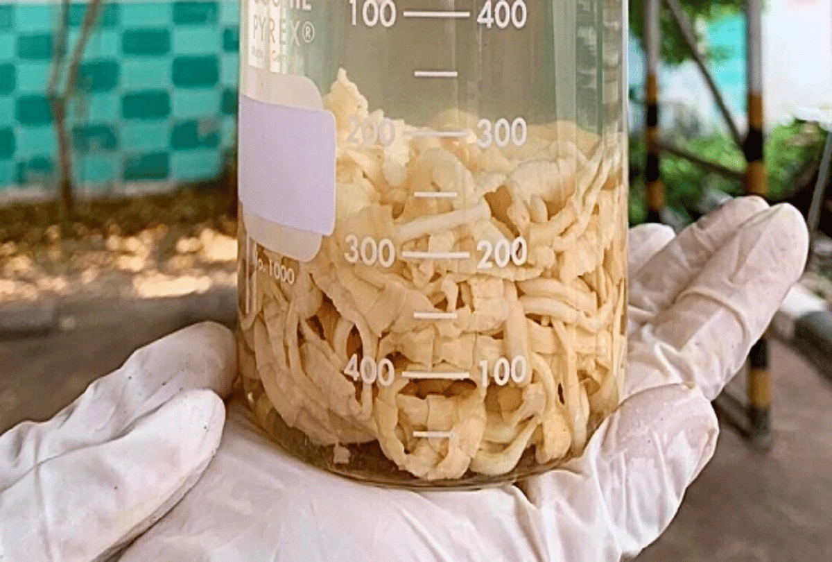 thailand 59 feet long tapeworm removed from mans rectum