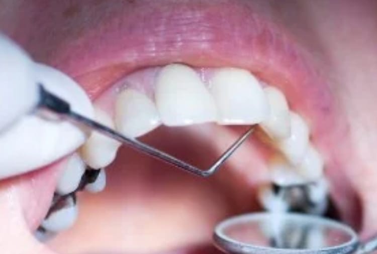 New variant of Corona also affects Teeth, says expert