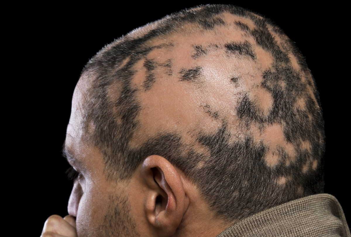 know the  symptoms and prevention of alopecia areata