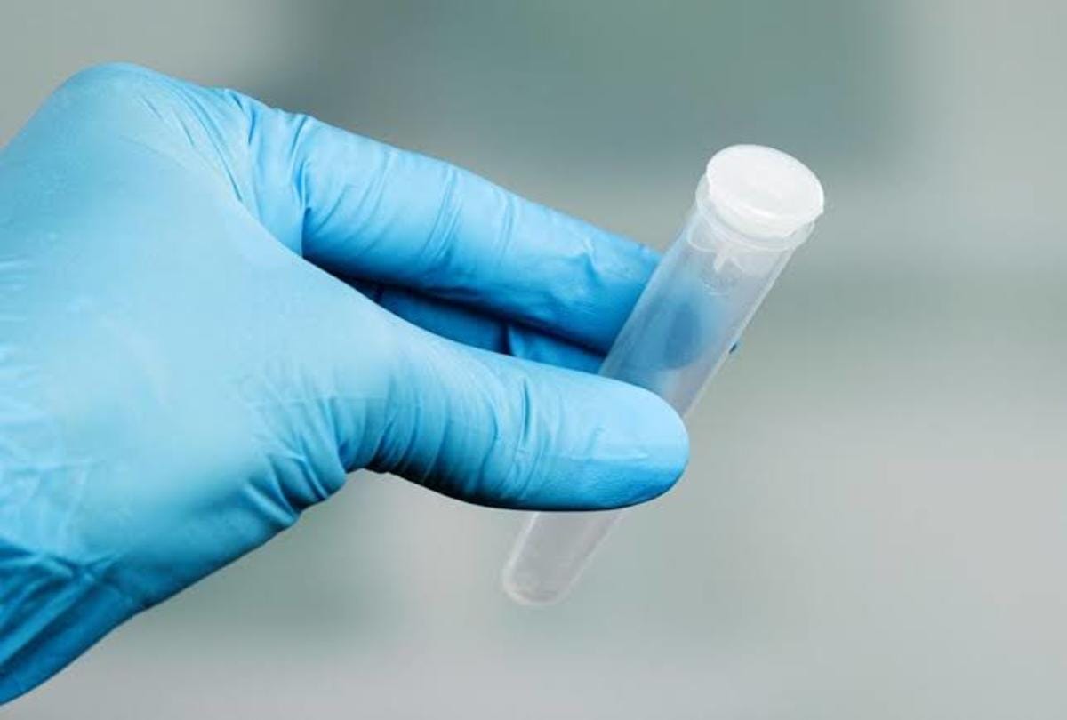 Research revealed that sperm of men weakened by coronavirus