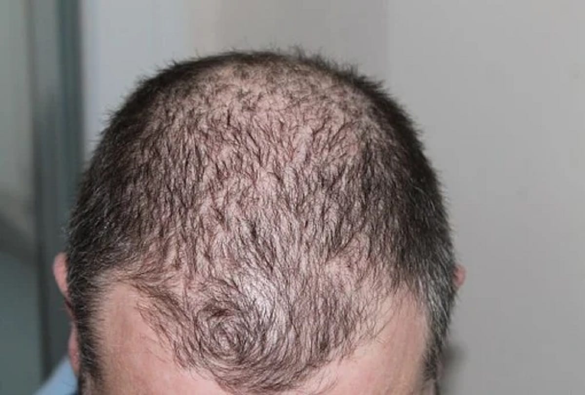 chronic stress leads to hair loss