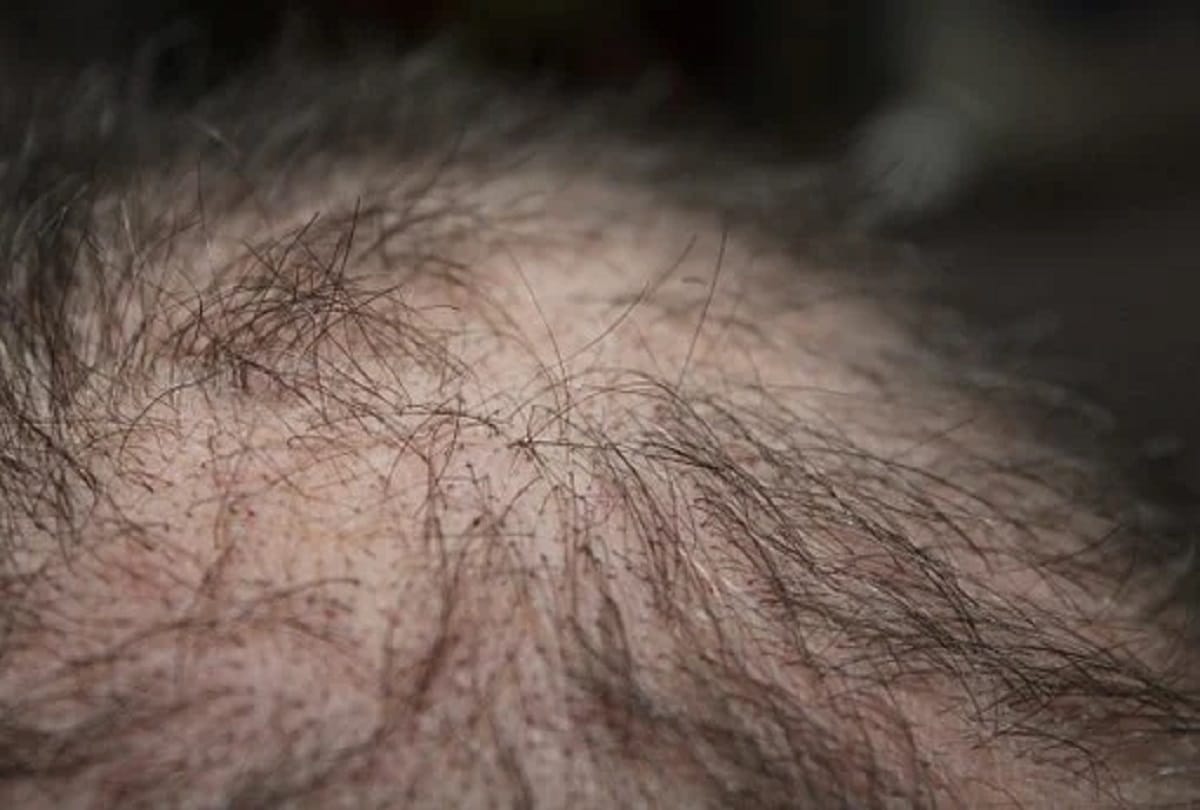 chronic stress leads to hair loss