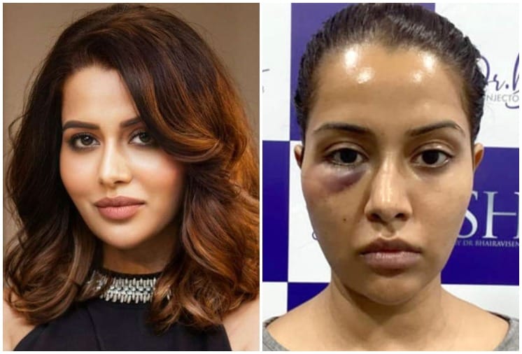 Tamil Actress Raiza Wilson Talks about her wrong Skin treatment, See Viral Photos