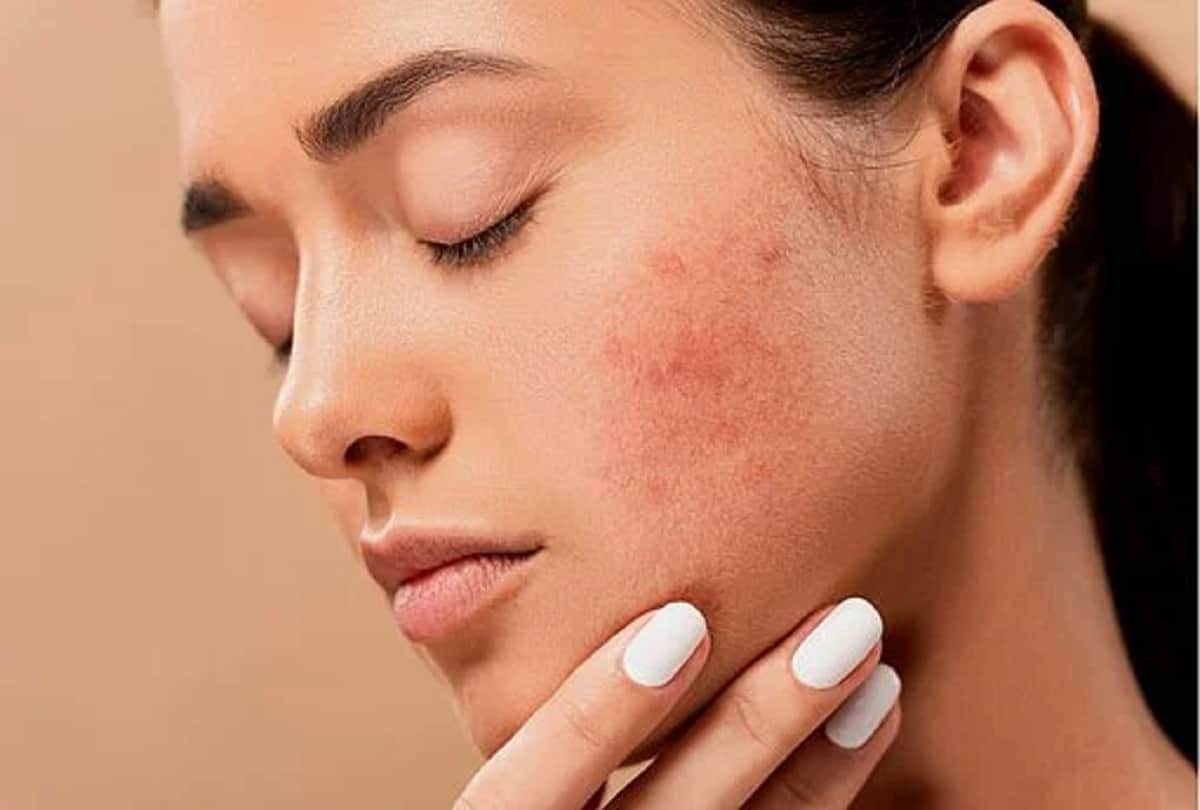 Skin Care Tips Apple Cider Vinegar Benefits For Skin Whitening Know How To Use