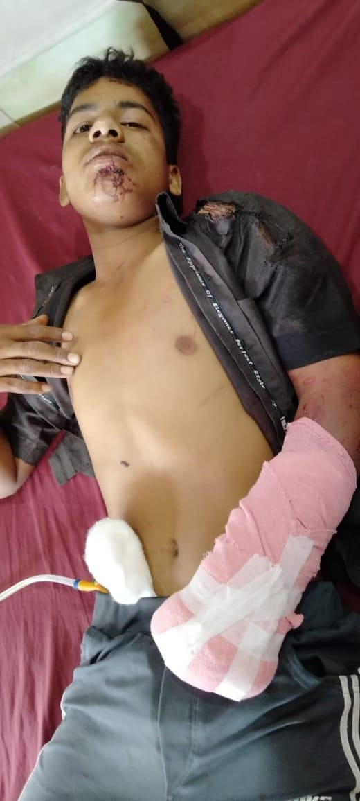 Hathras: Teenager's chopped hand while removing wheat from thresher
