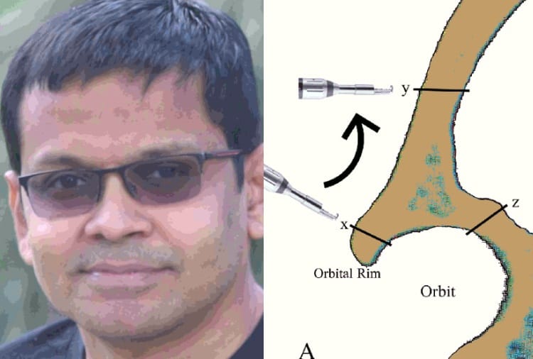 Chandigarh PGI Invent New Technique For Brain Surgery