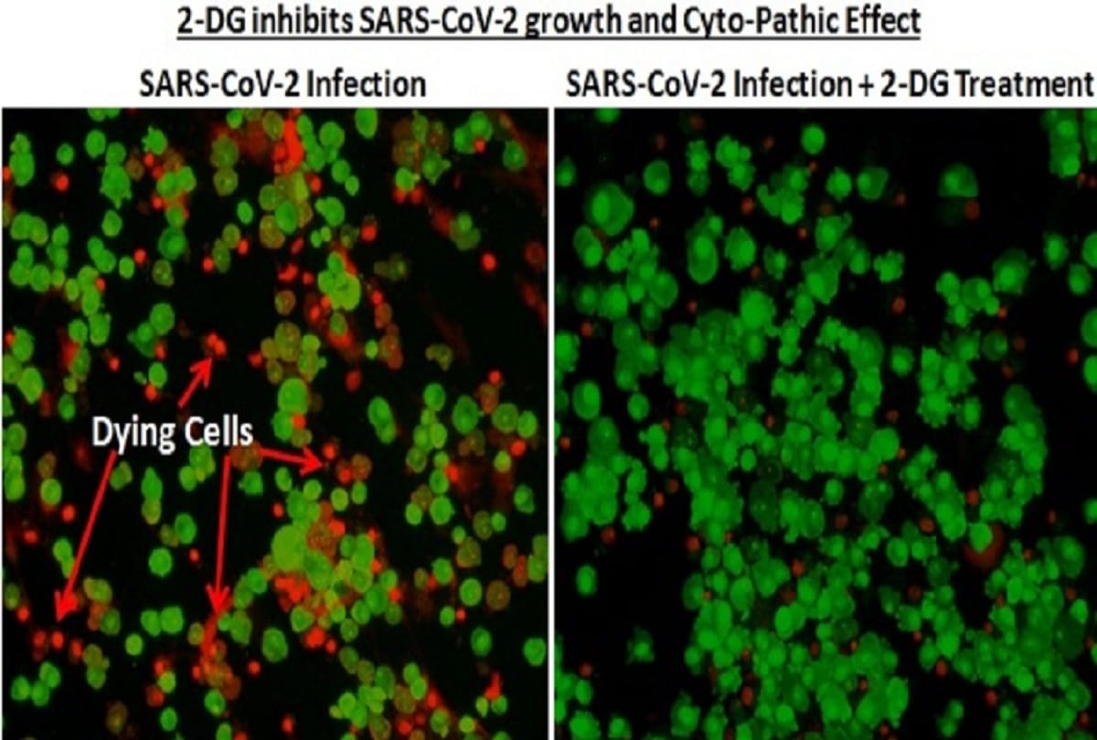 anti Covid drug 2dg powder makes lungs strong Corona patients seem to be healthy in three days