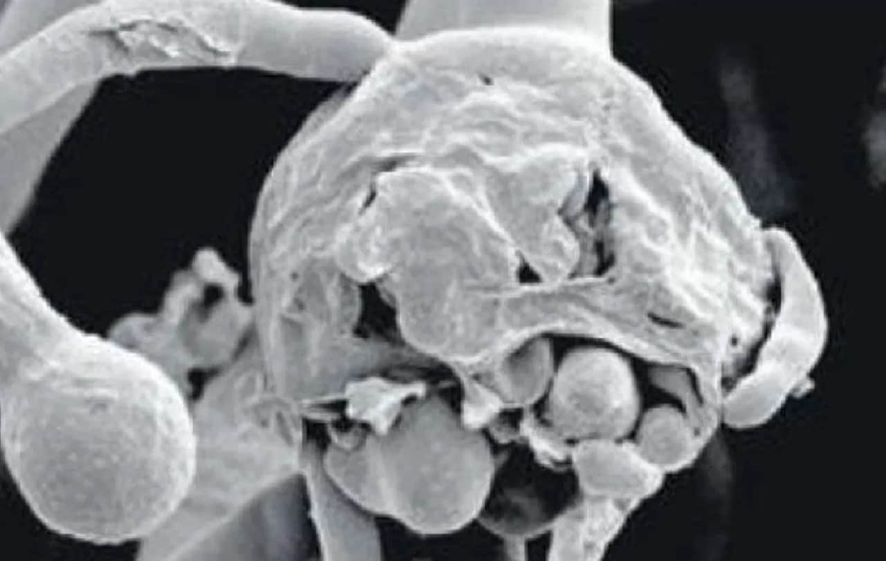 Black fungus patients will be operated daily in Gorakhpur Medical College