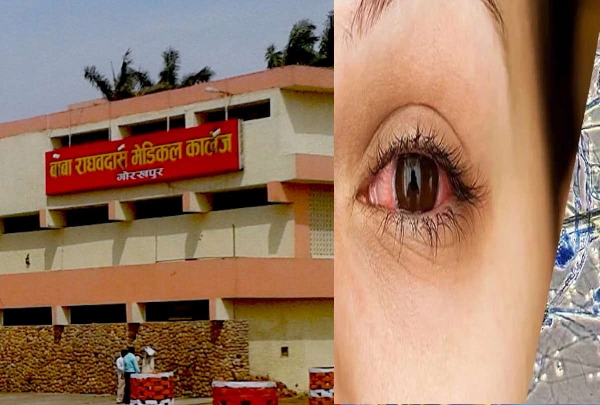 Two black fungus patients operated in Gorakhpur BRD Medical College