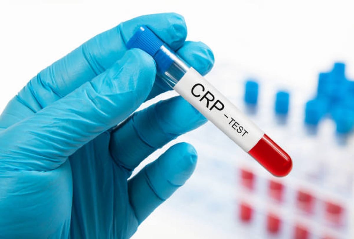 Coronavirus what is crp test how crp test useful in covid 19