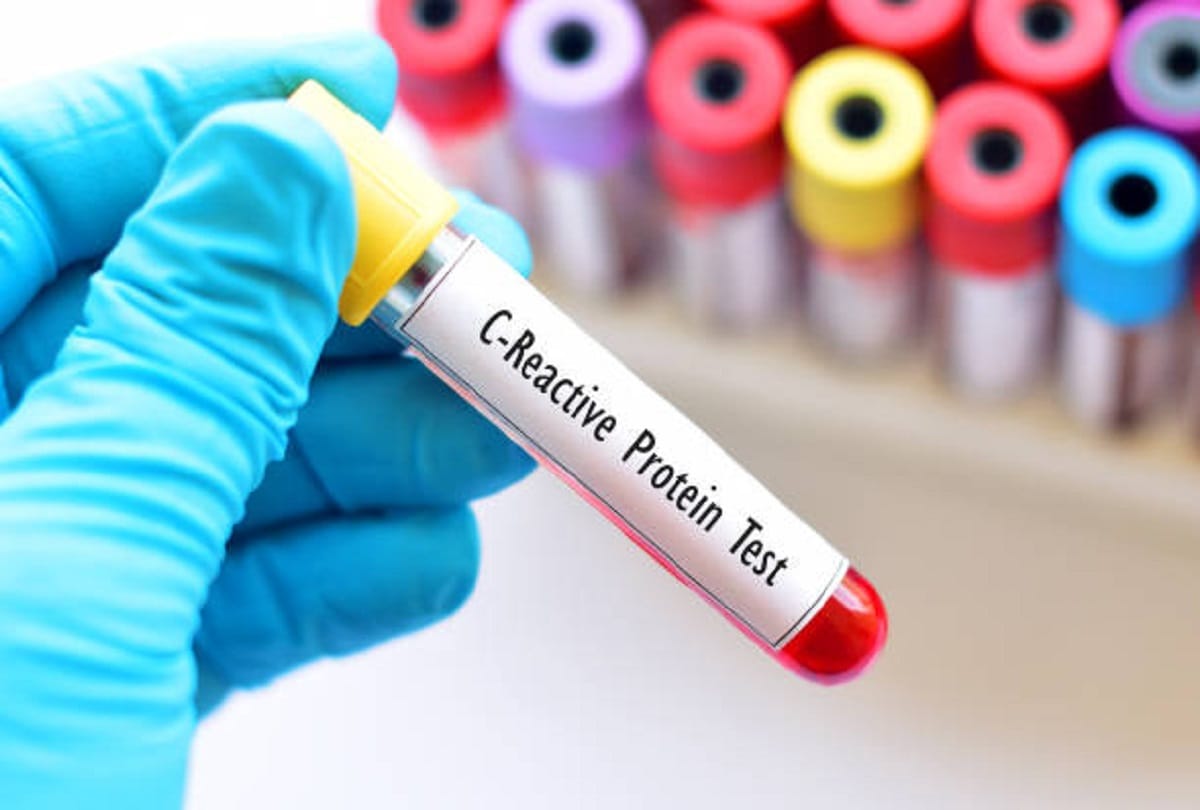 Coronavirus what is crp test how crp test useful in covid 19