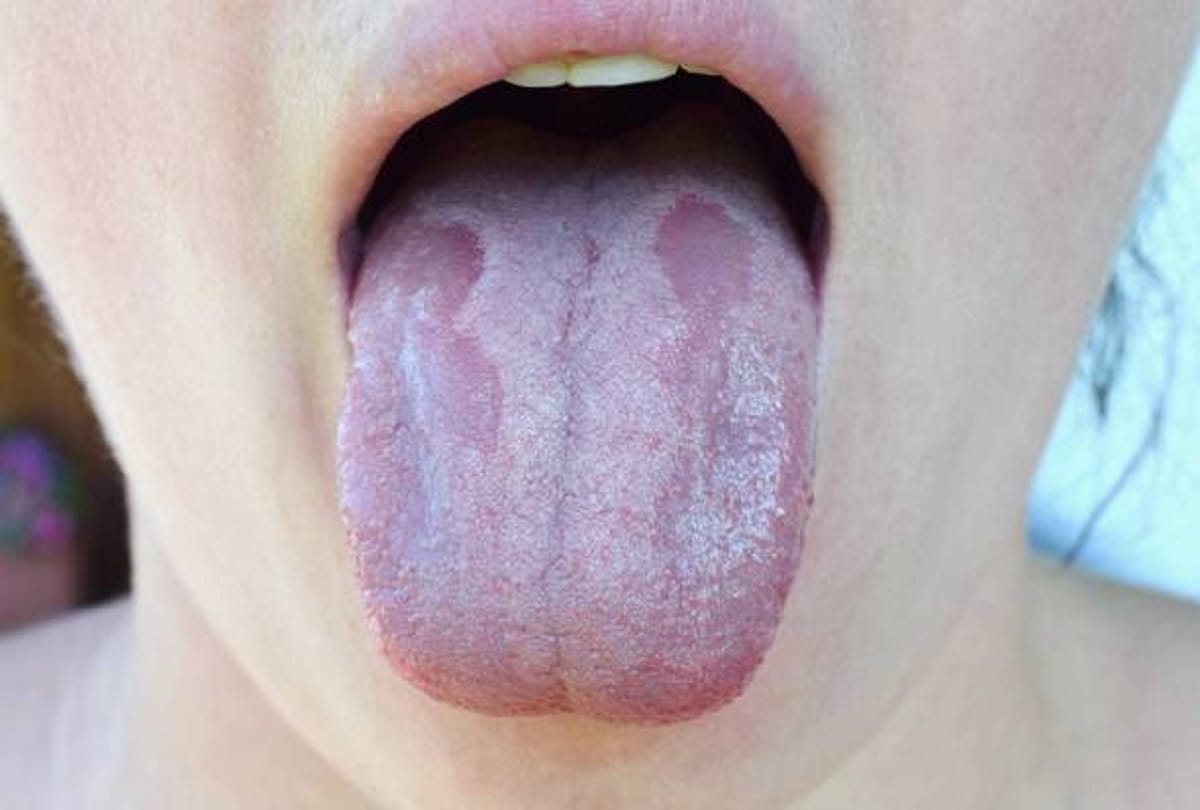 Coronavirus Mucormycosis in India know the Difference between black white and yellow fungus and symptoms