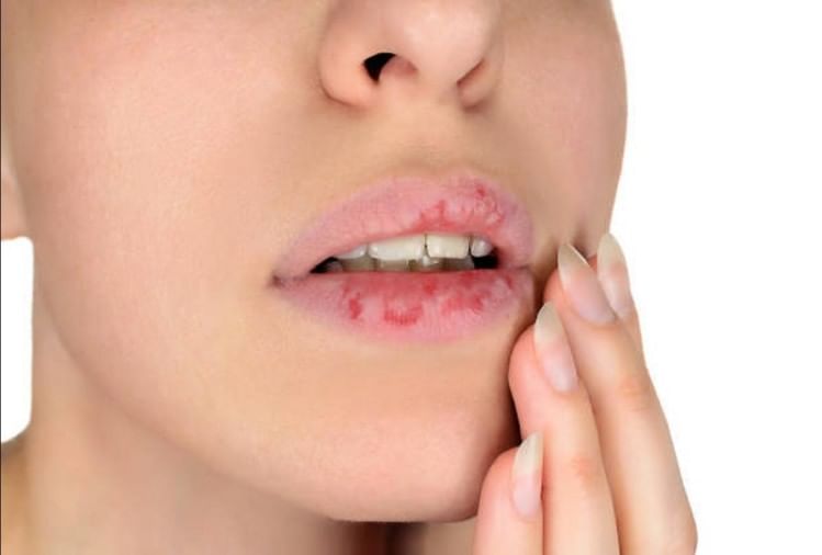 Lips Problem In Summerगर्मियों में होंठ फटने से रहते हैं परेशान? यह