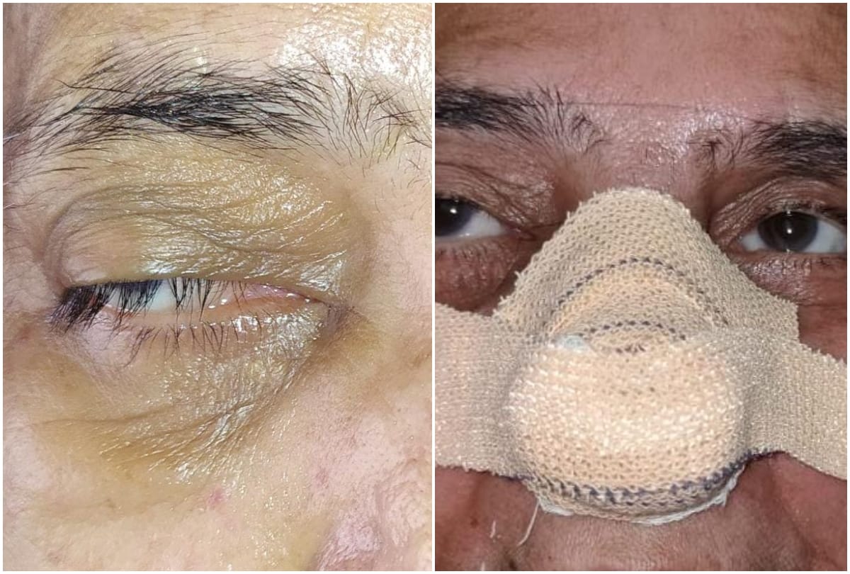 Sn Medical College Doctor Operation Black Fungus In Eye