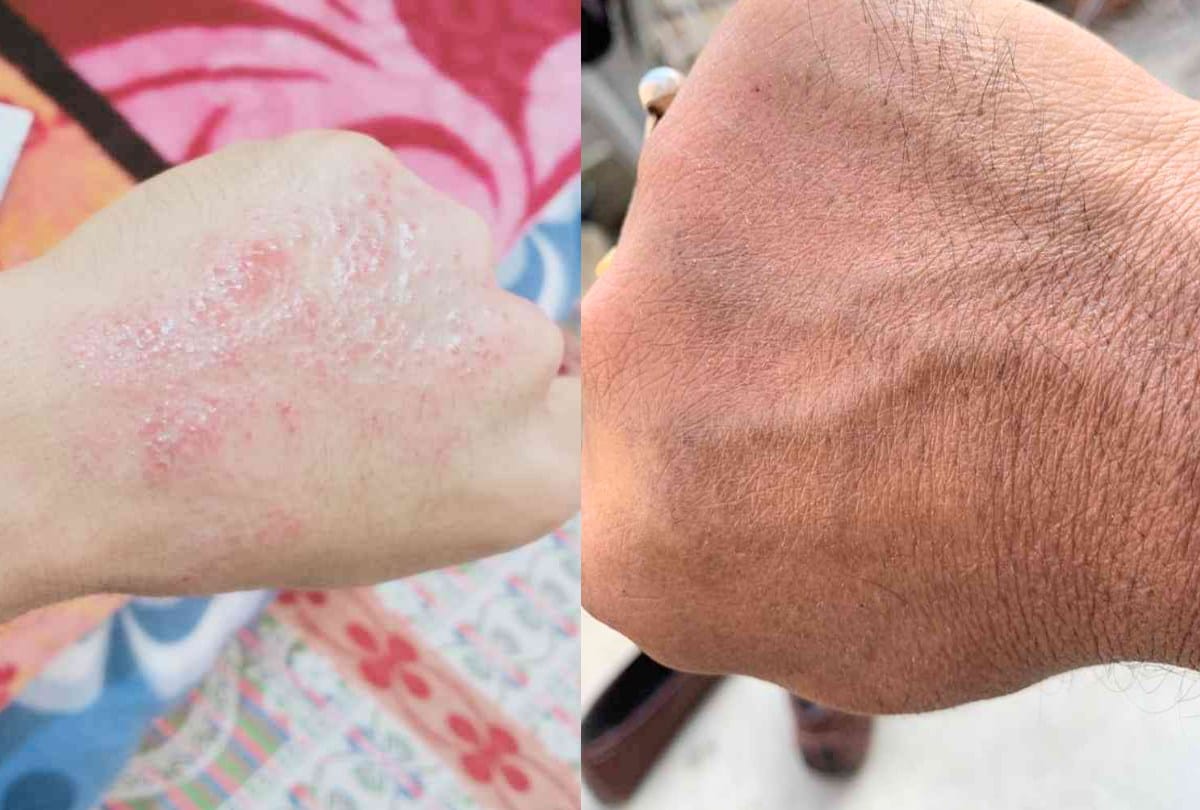 Hand skin getting worse due to excessive use of sanitizer